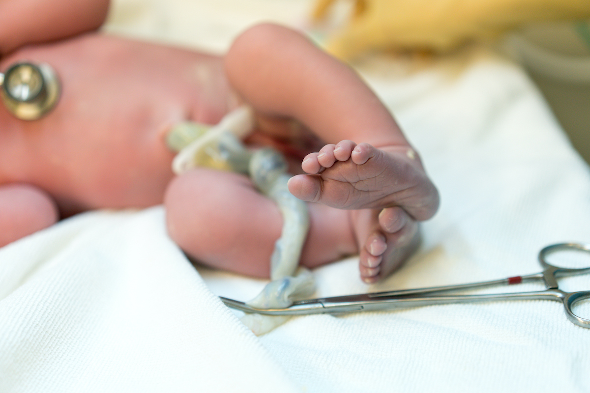 Baby's umbilical cord being cut