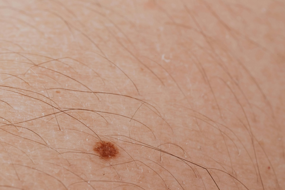 Light skin with body hair and a mole