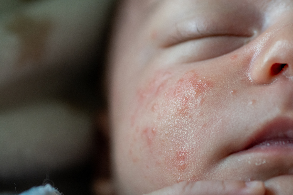 Baby's face with tiny red acne